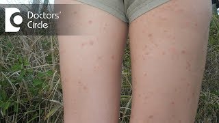 How to manage inner thigh rashes in teenagers  Dr Urmila Nischal [upl. by Olimpia]