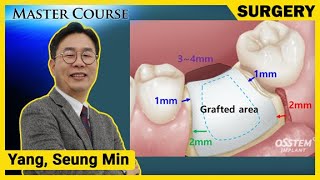 Master Course Season2  SURGERY Treatment Modality Based on Bone Defects  GBR [upl. by Elene]