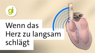 First Degree Atrioventricular Block ECG [upl. by Mayrim]