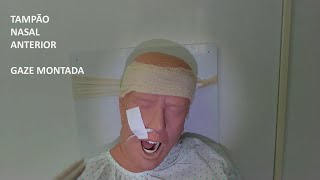 Septoplasty Day 3 nasal packing removal [upl. by Minnaminnie196]