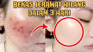 4 TIPS MENGHILANGKAN BEKAS JERAWAT PALING MUDAH DENGAN BAHAN ALAMI [upl. by Mikaela921]