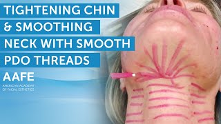 Tightening the Chin and Smoothing Neck with Smooth PDO Threads  AAFE [upl. by Stanford561]