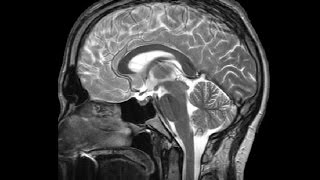 The Ventricles Neuroanatomy Video Lab  Brain Dissections [upl. by Queen]