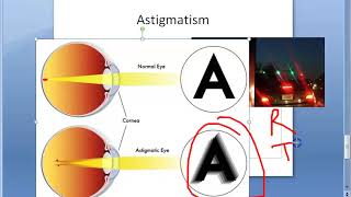 Ophthalmology 044 a Refractive Errors Of Refraction Emmetropia Ametropia Myopia HyperMetropia Eye [upl. by Shaner]