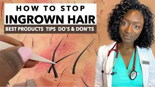 How to Stop Ingrown Hair amp Razor Bumps from Waxing amp Shaving  Treatments amp Products  Black Skin [upl. by Ellecram]