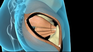 Arthroplastie totale de hanche [upl. by Frodin544]