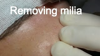 Milia and whiteheads total face removalPart 1 [upl. by Khalid]