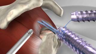 Knotless Rotator Cuff Repair with Arthrex® SpeedFix™ [upl. by Aires]