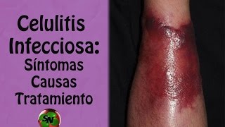 Celulitis infecciosa Síntomas causas factores de riesgo y tratamiento [upl. by Bridges645]