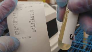 Urinalysis Chemical analysis of 3 patient urine specimens [upl. by Aisiram]