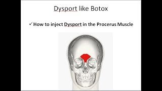 How to inject Dysport in the Procerus Muscle [upl. by Amara]