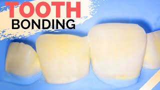 Teeth Bonding Procedure  Front Tooth Filling to Repair Chipped Tooth [upl. by Hersh]