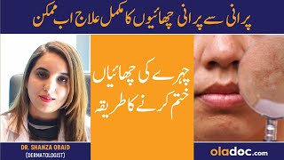 MELASMA Treatment Chaiyon Ka Ilaj  How To Get Rid Of Pigmentation  Chaiyan Khatam Karne Ka Tarika [upl. by Nylidam]