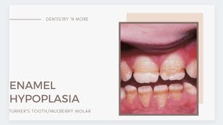 ENAMEL HYPOPLASIATURNERS TOOTH amp MULBERRY MOLARS [upl. by Aivatal]