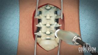 Lumbar Discectomy Surgery Medical Animation [upl. by Quince]