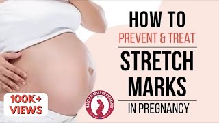 How to prevent and treat Stretch Marks in pregnancy Dr Anjali Kumar  Maitri [upl. by Enirbas]