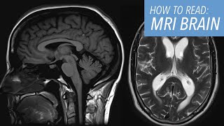 How to Read a Brain MRI Basic Search Pattern amp Sequences Explained [upl. by Ettegirb]